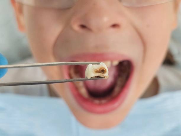 Best Urgent Care for Lost Fillings or Crowns in Olean, NY